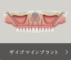 ザイゴマインプラント