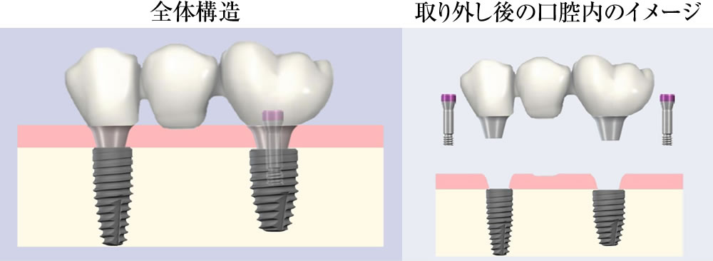 SRAアバットメント