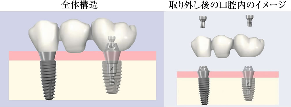 SRAアバットメント