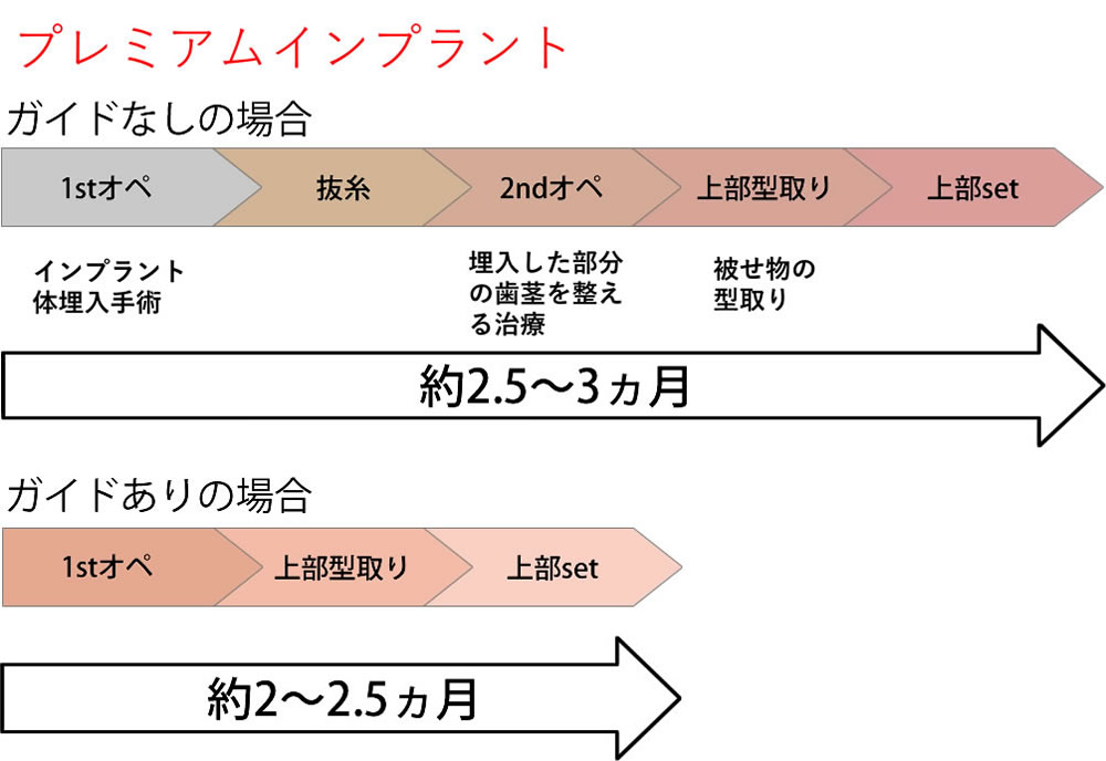プレミアムインプラントの治療期間